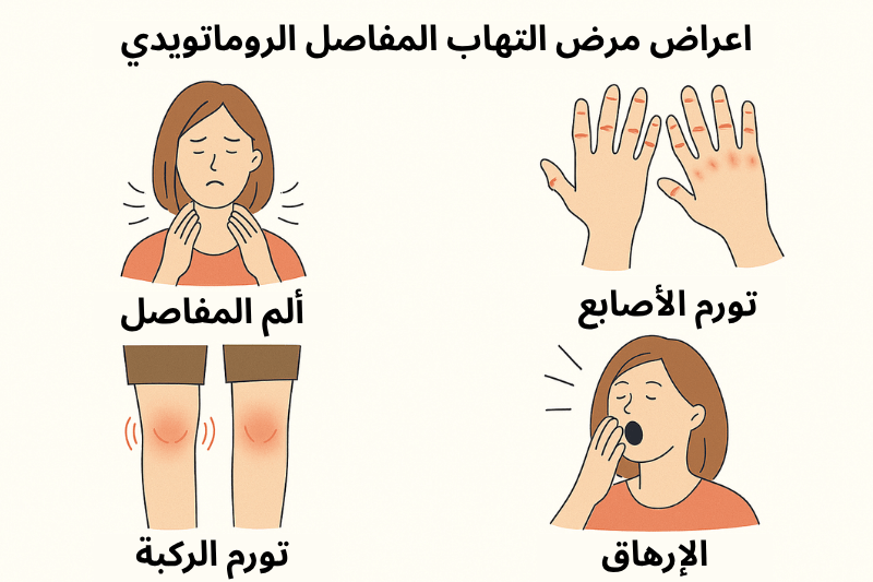 أعراض التهاب المفاصل الروماتويدي مثل ألم المفاصل، تورم الأصابع والركبة، والإرهاق المزمن – رسم توضيحي طبي